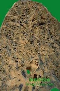 枸櫞酸桿菌肺炎