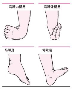 筋膜間隔區內綜合徵 筋膜間隔區內綜合徵