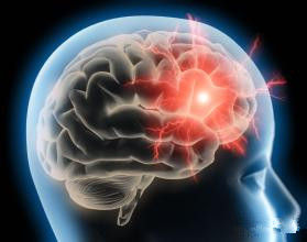 腦血管疾病 腦血管疾病