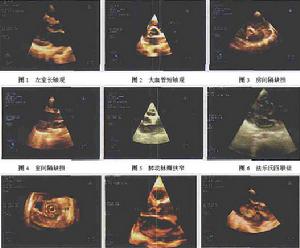 胸主動脈夾層動脈瘤