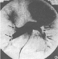 脂肪栓塞綜合徵