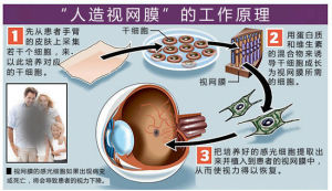 人造視網膜”的工作原理