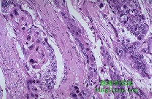 十二指腸胃反流