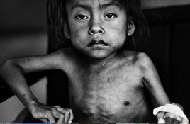 營養消瘦症 營養消瘦症