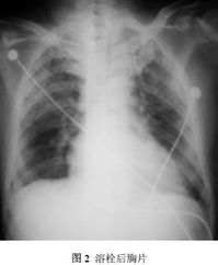 小兒肺出血-腎炎綜合徵 小兒肺出血-腎炎綜合徵