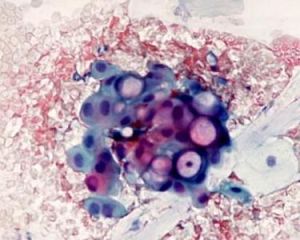 肺炎衣原體感染 肺炎衣原體感染