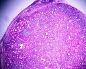 橋本氏甲狀腺炎，切面結節狀