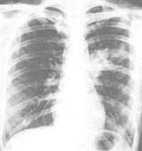 支原體肺炎 支原體肺炎