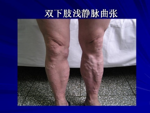 靜脈曲張