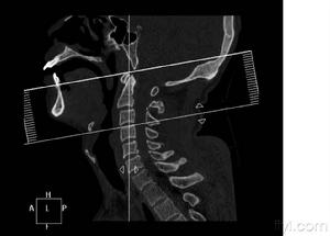 頸髓損傷 頸髓損傷