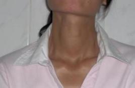 甲亢肌無力 甲亢肌無力