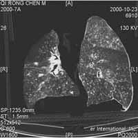 煤工塵肺 煤工塵肺