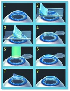 近視眼雷射手術