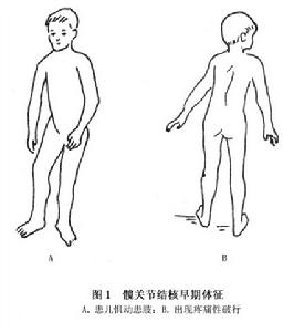 （圖）髖關節結核病