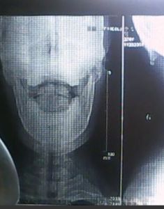 腦後有反骨 腦後有反骨