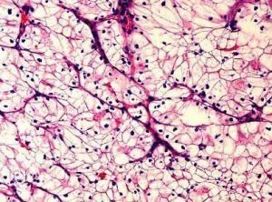 腎透明細胞癌