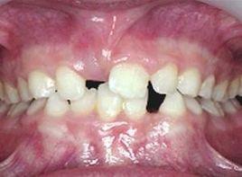 牙齒小且無光澤 牙齒小且無光澤