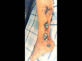 真菌性敗血症 真菌性敗血症