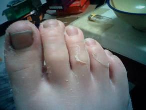 手腳脫皮病 手腳脫皮病