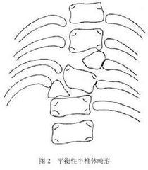 半椎體畸形 半椎體畸形