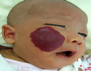 紅色胎記 紅色胎記