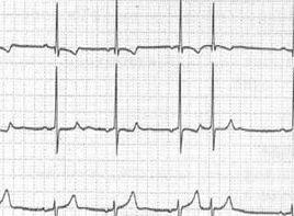 房性逸搏心律加速 房性逸搏心律加速