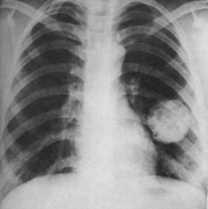 肺部良性腫瘤