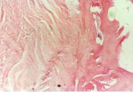 骨內膜炎 骨內膜炎