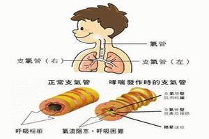 食物誘發哮喘