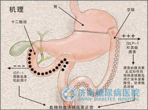 胃轉流手術示範圖