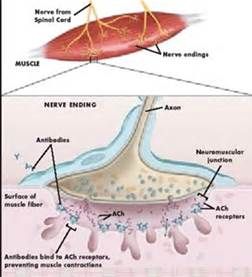 神經肌肉接頭疾病 神經肌肉接頭疾病