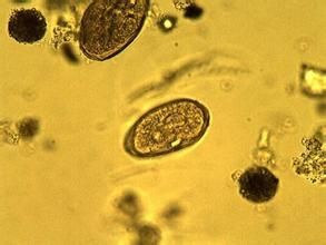 四川並殖吸蟲病 四川並殖吸蟲病