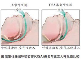 呼吸暫停綜合徵 呼吸暫停綜合徵