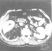 腎周膿腫 腎周膿腫