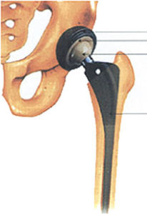 人造髖關節 人造髖關節