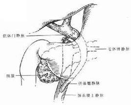 下腔靜脈成形術 下腔靜脈成形術