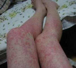 食物過敏症 食物過敏症