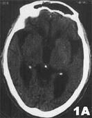 賓斯旺格病 賓斯旺格病