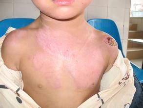 小兒燙傷 小兒燙傷