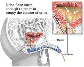 真性尿失禁 真性尿失禁
