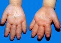 淋巴水腫 淋巴水腫