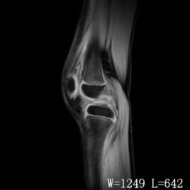 半月板囊腫 半月板囊腫