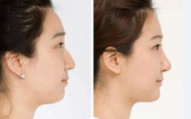3D無痕隆鼻 3D無痕隆鼻
