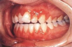 牙齦增生 牙齦增生