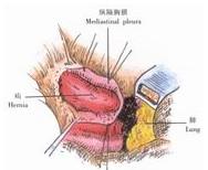 示意圖1:切開縱隔胸膜