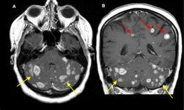 腦轉移瘤 腦轉移瘤