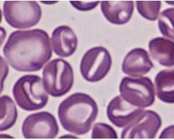 口形紅細胞：增多見於遺傳口（遺傳性口形紅細胞增多症）。