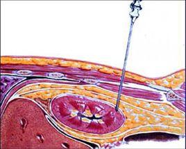 腎活檢病理學 腎活檢病理學