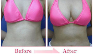 內窺鏡隆胸手術 內窺鏡隆胸手術