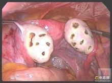 多囊卵巢綜台征閉經症 多囊卵巢綜台征閉經症